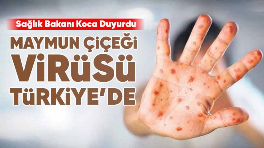 Bakan Koca Açıkladı, Maymun Çiçeği Virüsü Türkiye'de