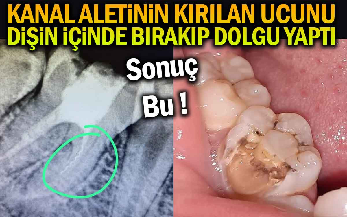 Dişin İçerisinde Kanal Aletinin Kırılan Ucunu Bıraktılar