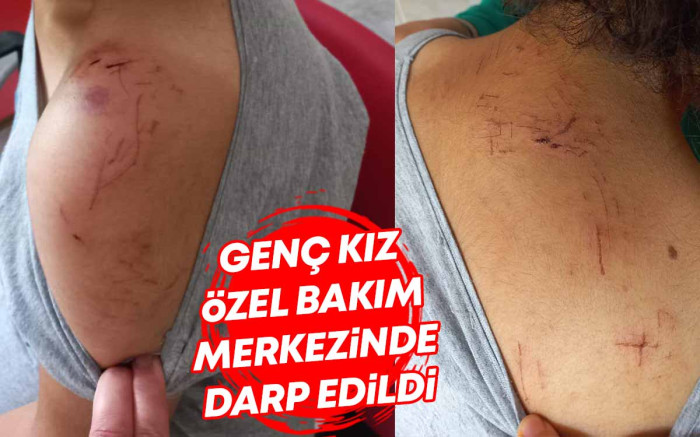 Genç Kız Özel Bakım Merkezinde Darp Edildi