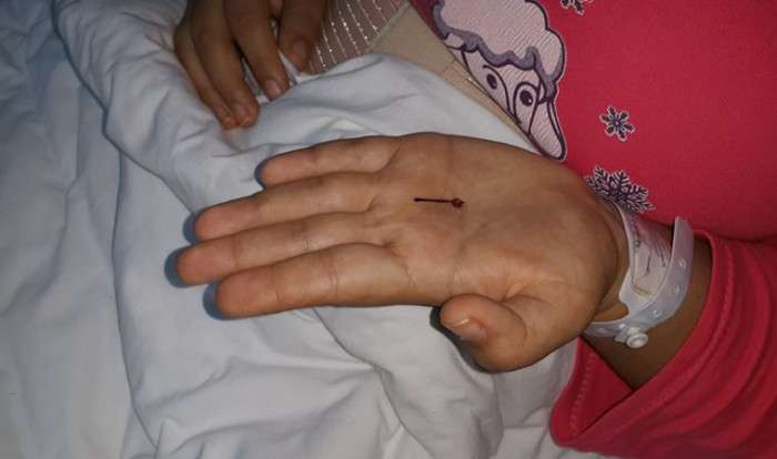 1 yaşında yuttuğu toplu iğneden yıllar sonra kurtuldu