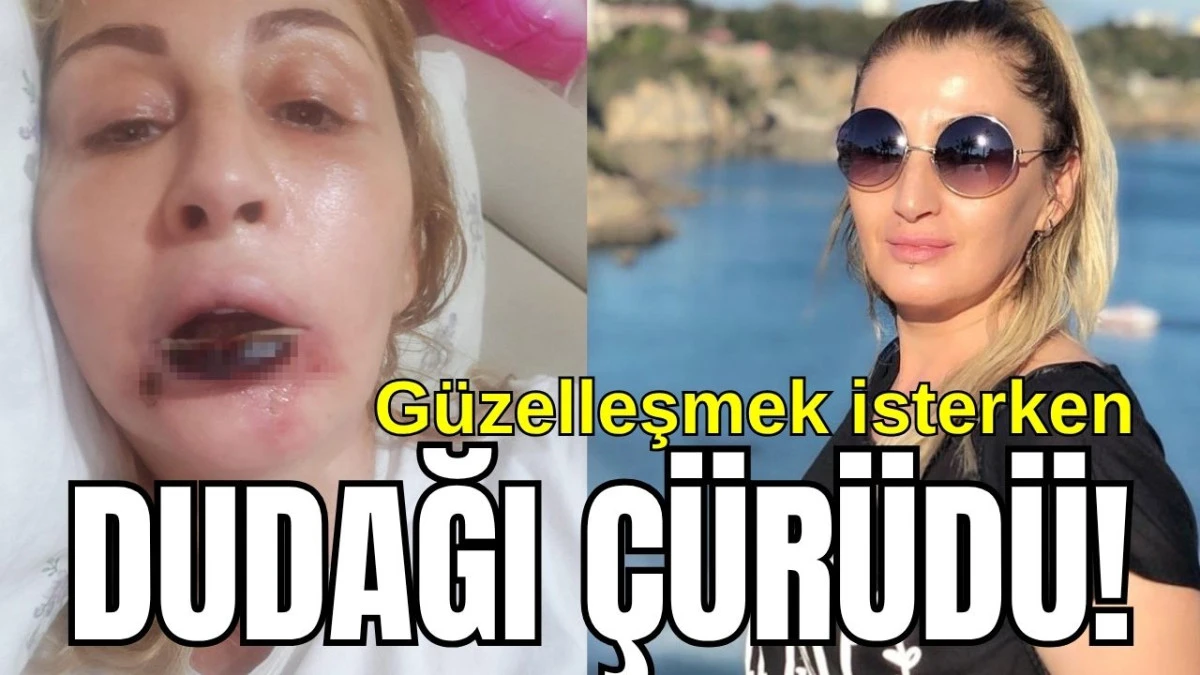 Antalya'da güzelleşmek isterken dudağı çürüdü!